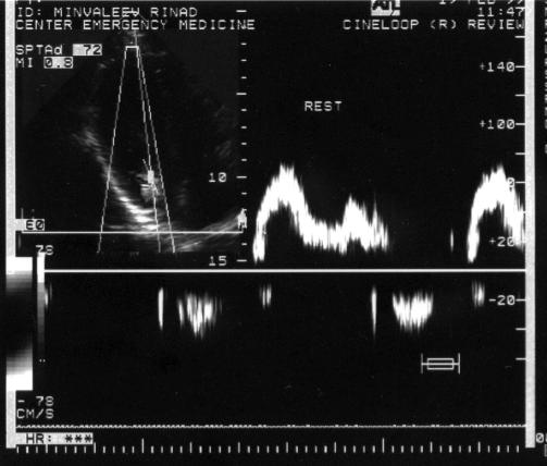 Fig. 4. Transmitral blood flow in the initial position