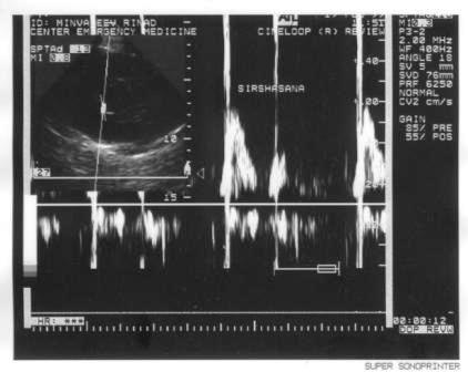 Fig.5. Transmitral blood flow during sirshasana