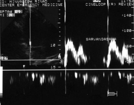 Fig.6. Transmitral blood flow during sarvangasana