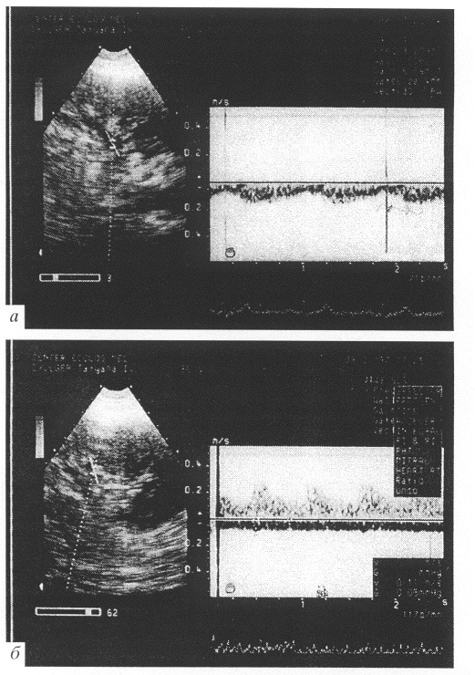 Fig. 3. Blood flow in the renal vein.  (A) Betore exercise: (B) during exercise.