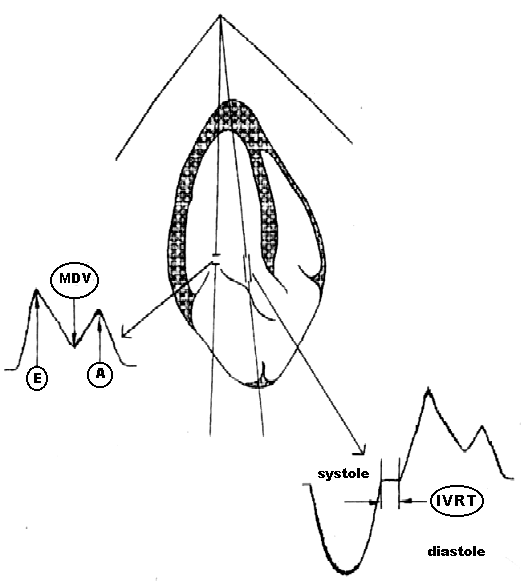 Abb. 6. Transmitraler Blutfluss (TMB)(bei Inspiration) waehrend der Sarvangasana (Schema)